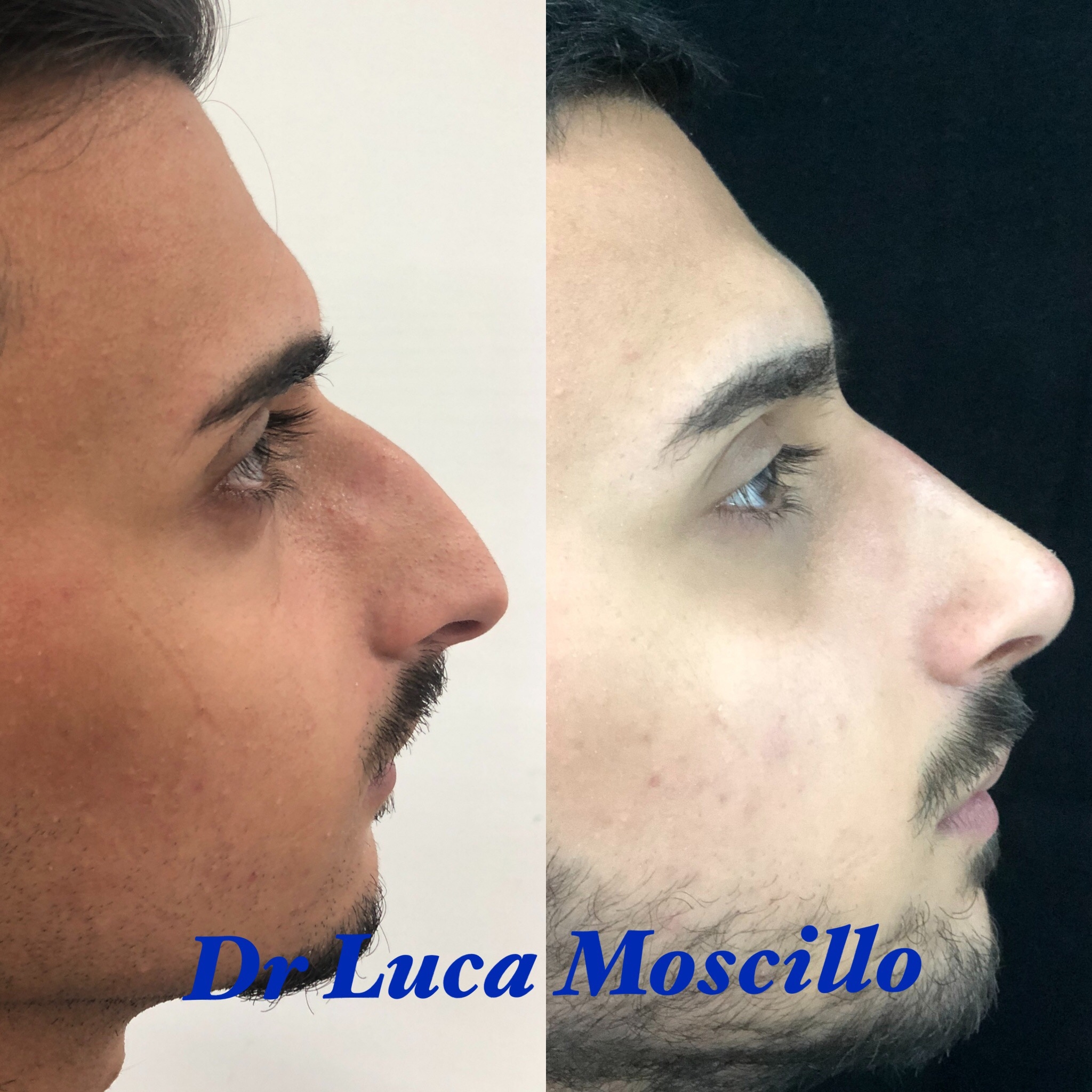 rhinoplasty italy